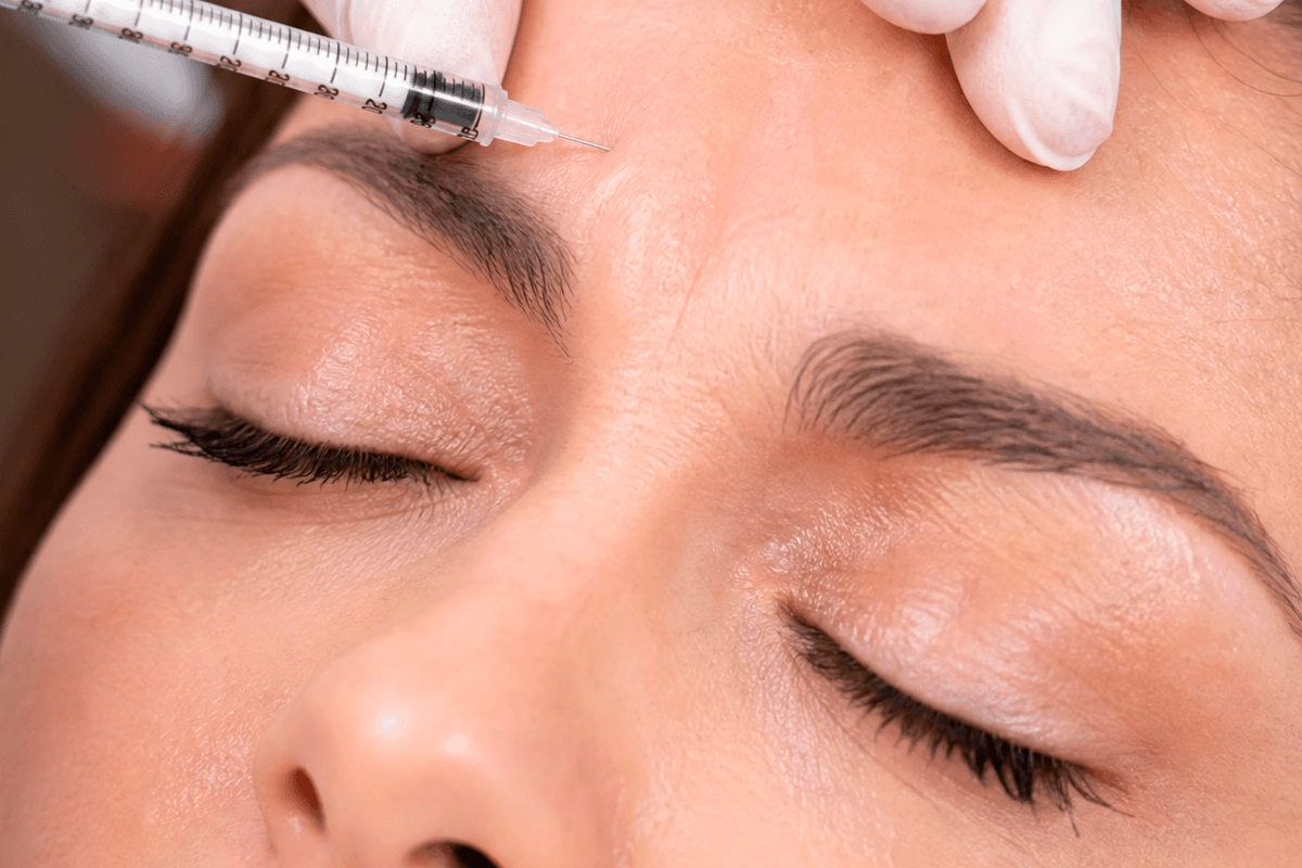 Aplicação de toxina botulínica (Botox) na região da testa