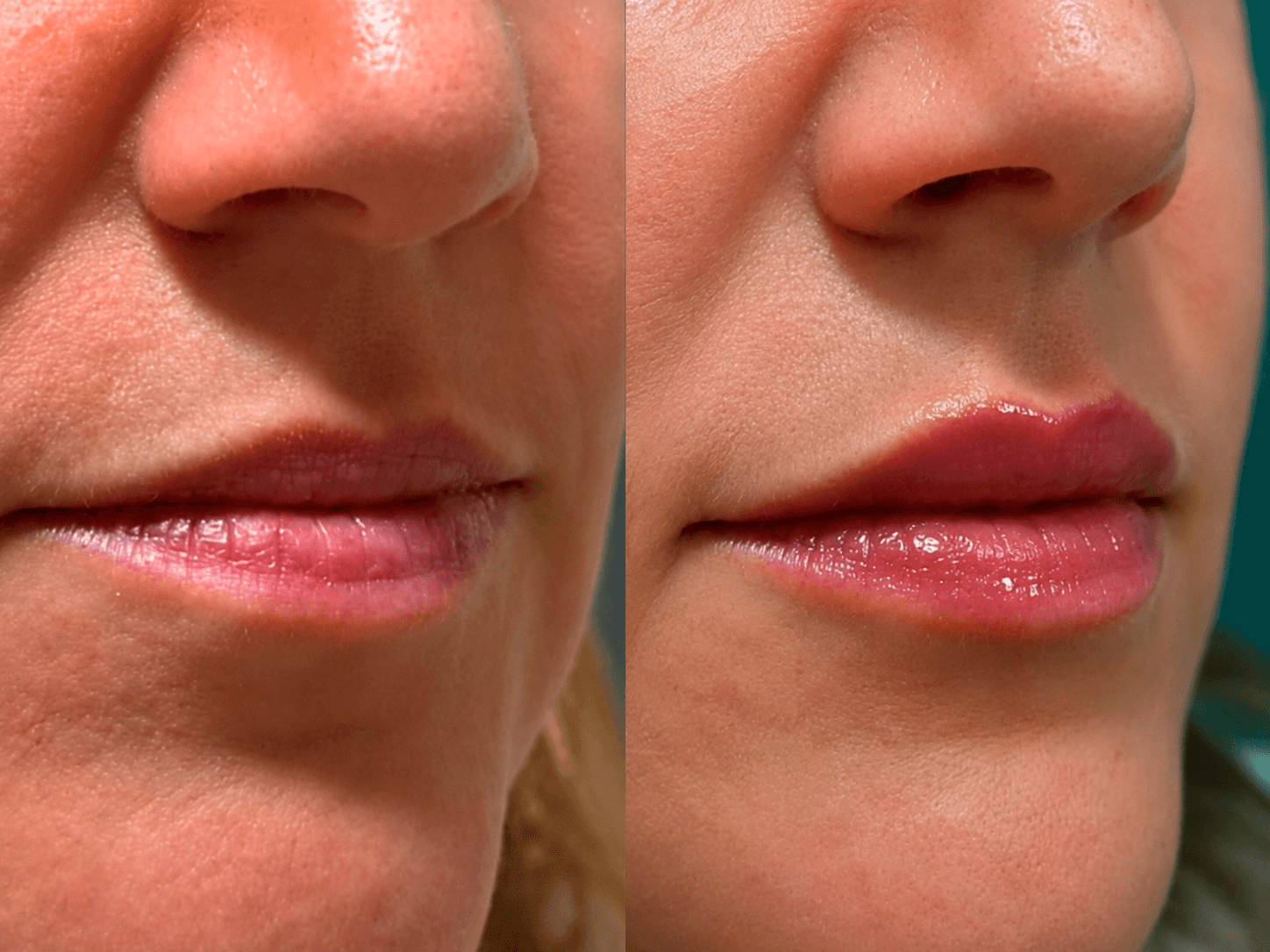 Comparação antes e depois de preenchimento labial