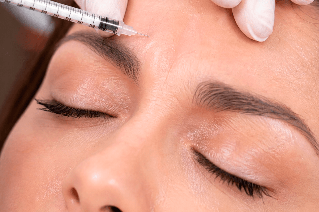 Aplicação de toxina botulínica (Botox) na região da testa