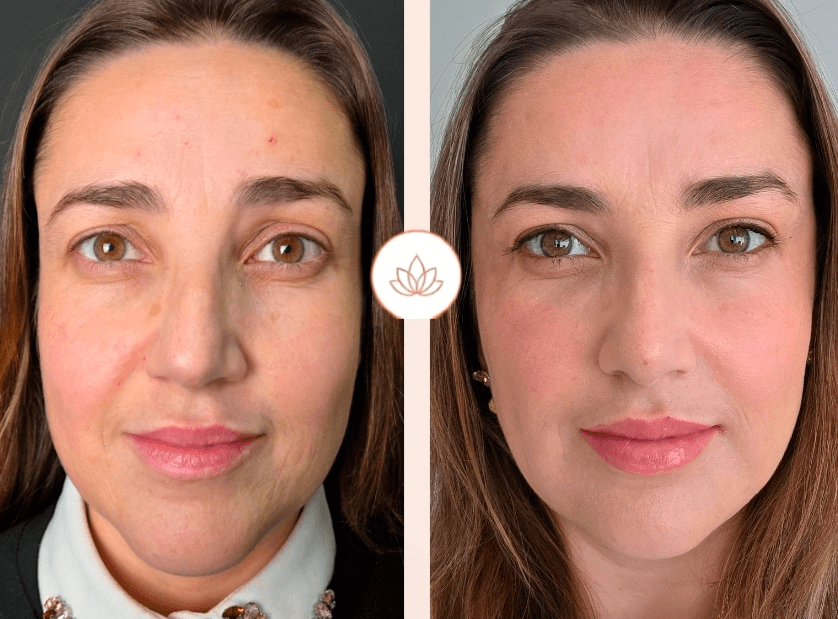 Comparação antes e depois de harmonização facial